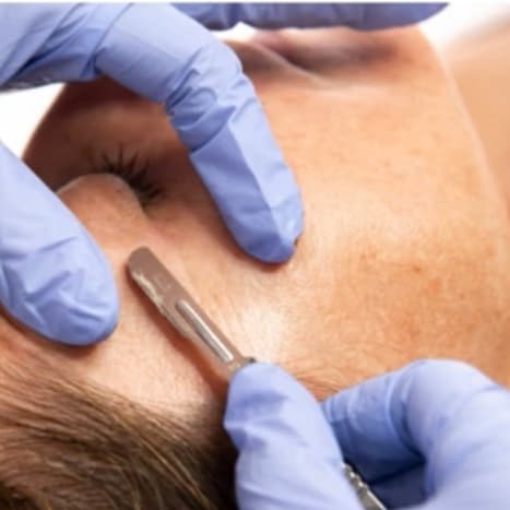 Dermaplaning Series of 3 at glazed glow aesthetics in Houston, TX